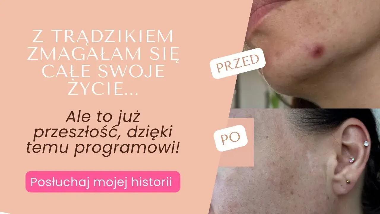 Co działa na pryszcze? Odkryj skuteczne metody i czystą cerę!
