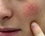 Czerwone ślady po pryszczach: Jak pozbyć się PIE i odzyskać gładką skórę?