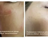 Cera naczynkowa: Pozbądź się rumienia! Pielęgnacja, zabiegi, dieta
