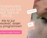 Co działa na pryszcze? Odkryj skuteczne metody i czystą cerę!
