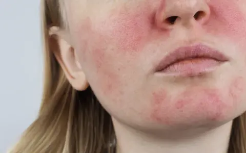 Cera naczynkowa: Jak dbać? Porady eksperta, kosmetyki, zabiegi
