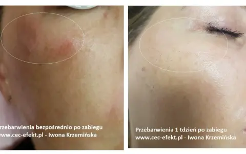 Cera naczynkowa: Pozbądź się rumienia! Pielęgnacja, zabiegi, dieta