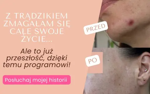 Co działa na pryszcze? Odkryj skuteczne metody i czystą cerę!