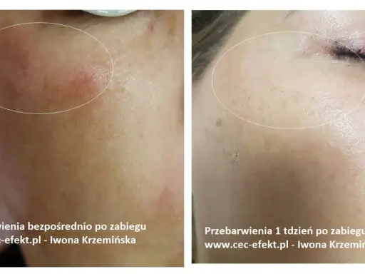 Cera naczynkowa: Pozbądź się rumienia! Pielęgnacja, zabiegi, dieta
