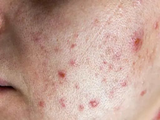 Pryszcze na brodzie: Hormony, dieta, pielęgnacja znajdź przyczynę!