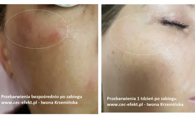 Cera naczynkowa: Pozbądź się rumienia! Pielęgnacja, zabiegi, dieta