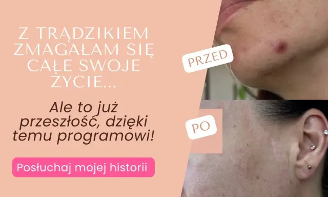 Co działa na pryszcze? Odkryj skuteczne metody i czystą cerę!