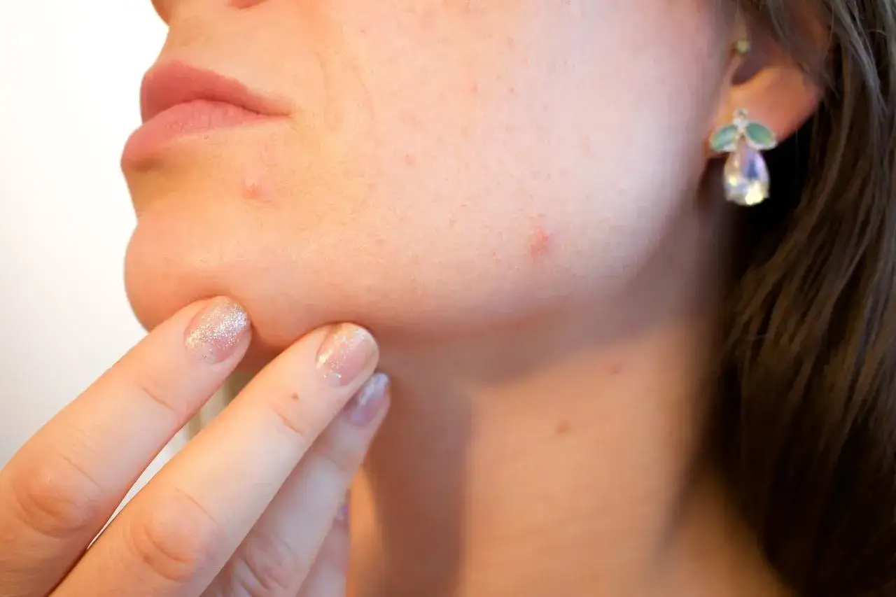 wizyta u dermatologa trądzik