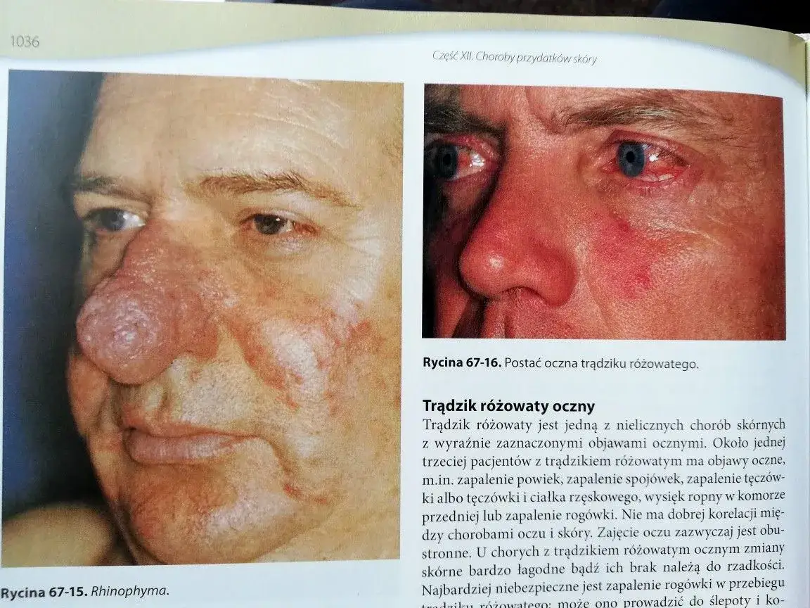 cera naczynkowa a trądzik różowaty różnice