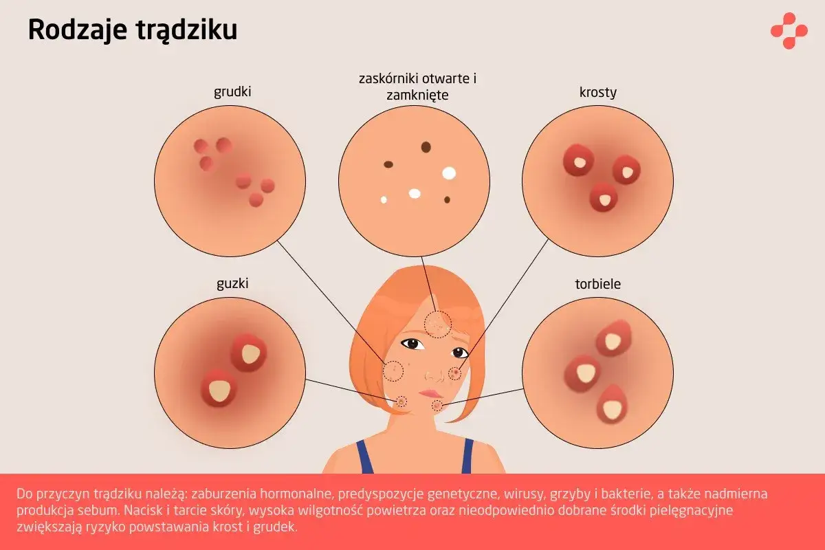Pryszcze na policzkach przyczyny